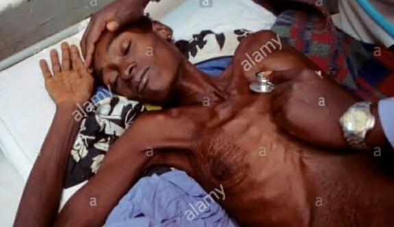 Wasada 75 % Terkena HIV/AIDS di Bali Usia Produktif, Denpasar Terbanyak